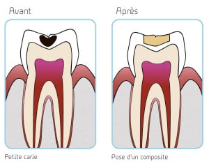 illustration carie débutante et pose d'un composite copyright Le studio dentaire