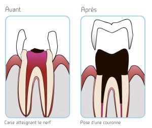 illustration carie atteignant le nerf et pose d'une couronne copyright le studio dentaire