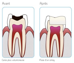 illustration carie volumineuse et pose onlay copyright studio dentaire