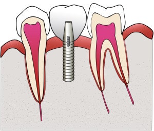 illustration couronne sur implant par le studio dentaire