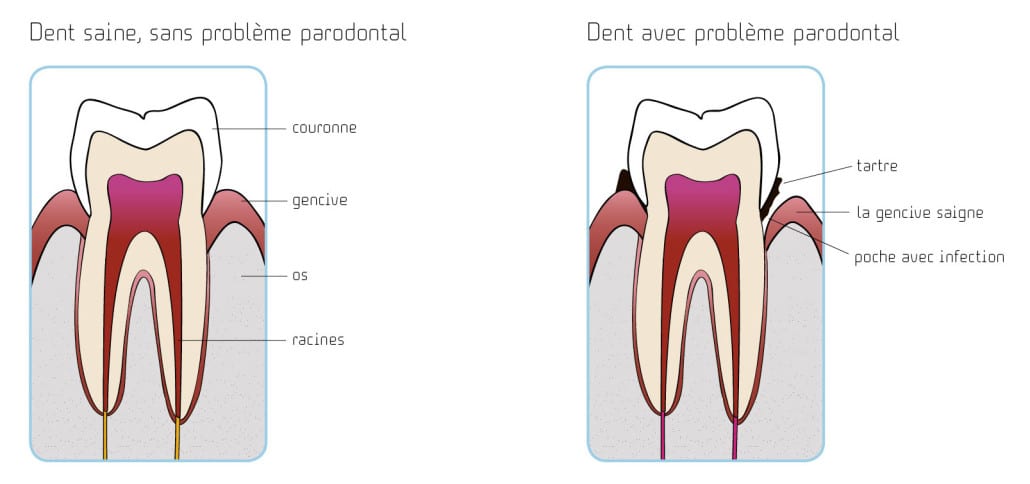 traitement parodontal illustration dent saine et dent avec parodontite