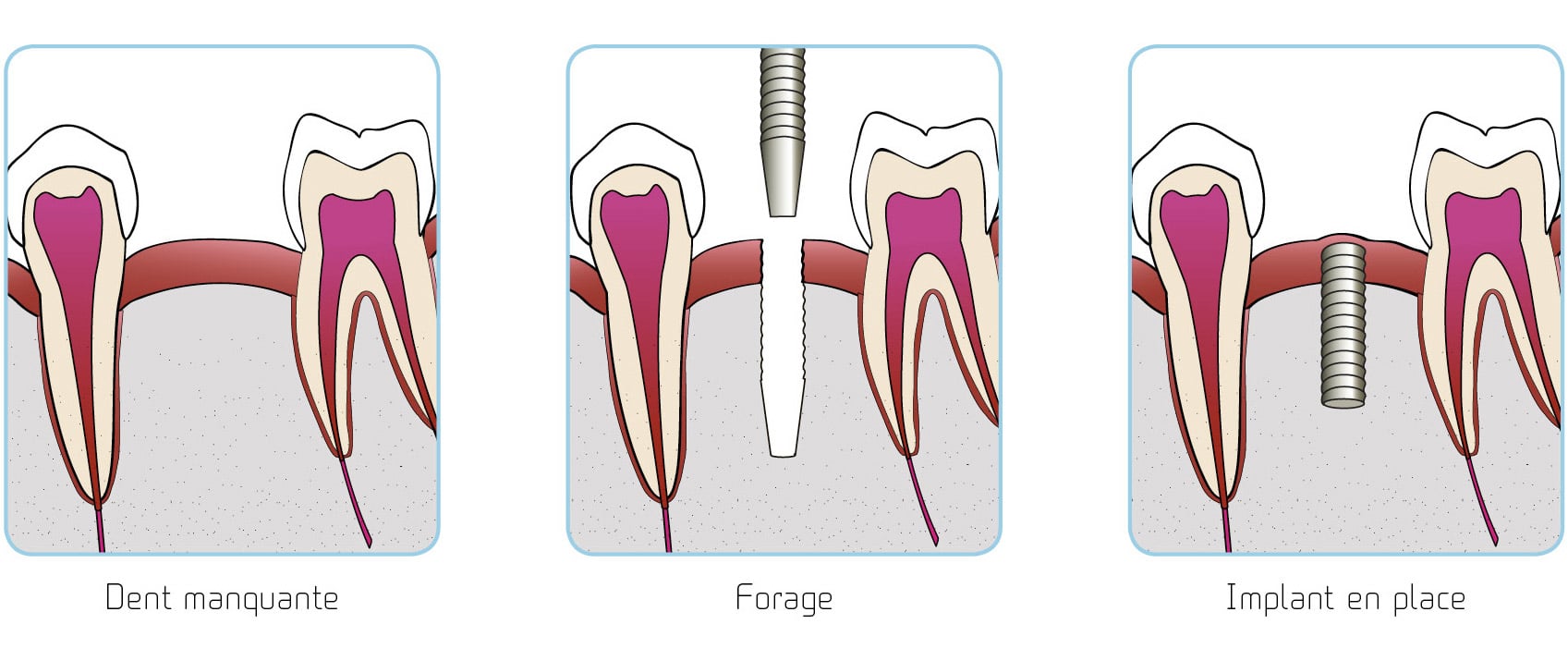 illustrations pose implant étape par étape copyright studio dentaire lyon