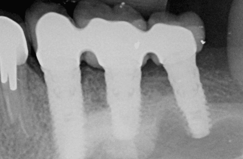 Implants dentaires sur radiographie studio dentaire lyon