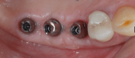 Implant-touati-dentiste-lyon-2