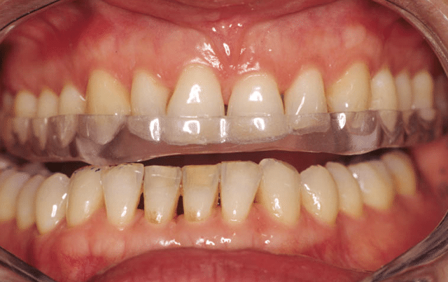 Bruxisme - Grincement des dents - Traitement - Le Studio Dentaire