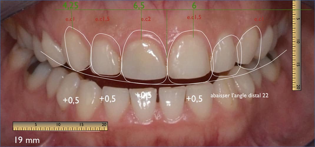 conception digitale nouveau sourire avec logiciel digital smile design