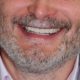 nouveau sourire après soins dentaires facettes couronnes