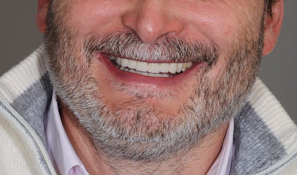 does tobacco cause bruxism Bruxism: Causes and Treatments Bruxism Symptoms, Causes, andTreatments 