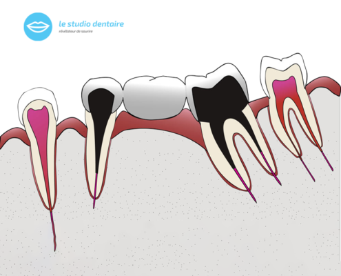 illustration bridge dentaire
