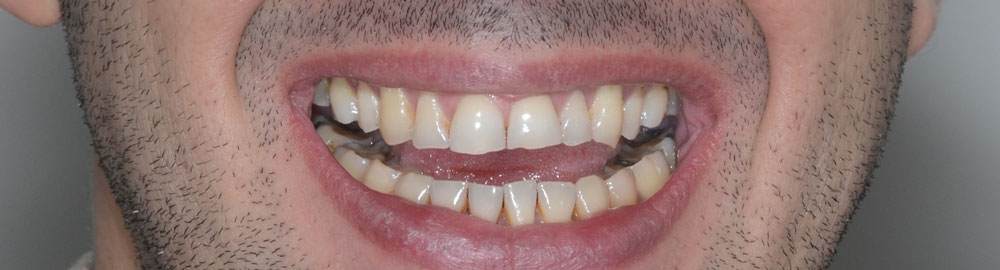 Grincement des dents : tout savoir sur le bruxisme ! – MyVariations