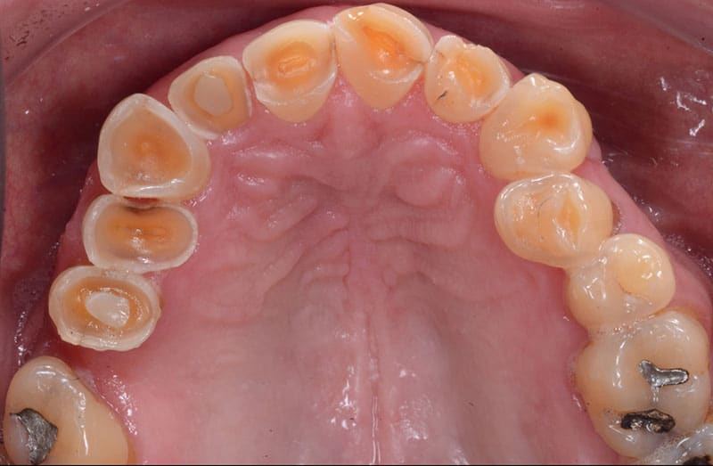 pose de Couronne dentaire : Restituer à l'identique une dent altérée