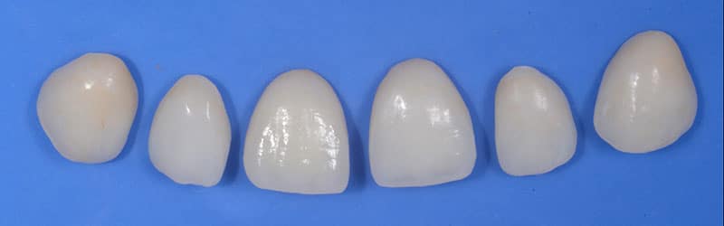 facettes dentaires en porcelaine