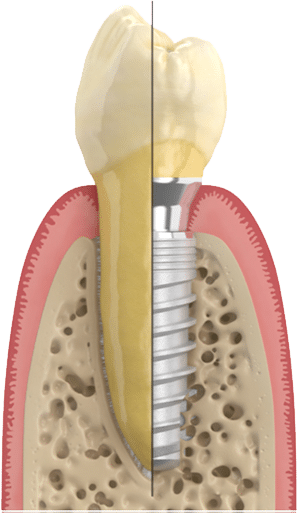 Implant Dentaire Plan de coupe