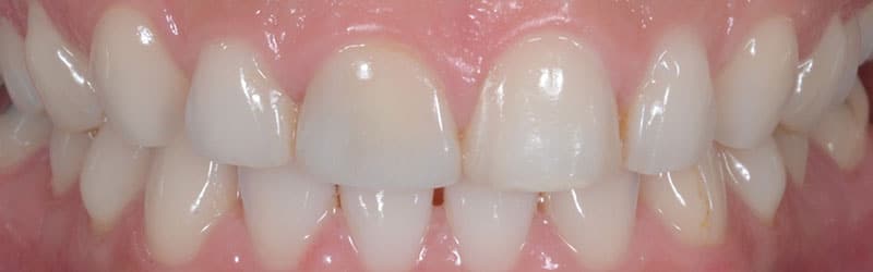 dentition avant facettes